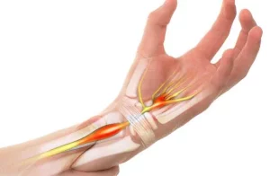 La sindrome del tunnel carpale è una forma di neuropatia da compressione che si verifica quando il...