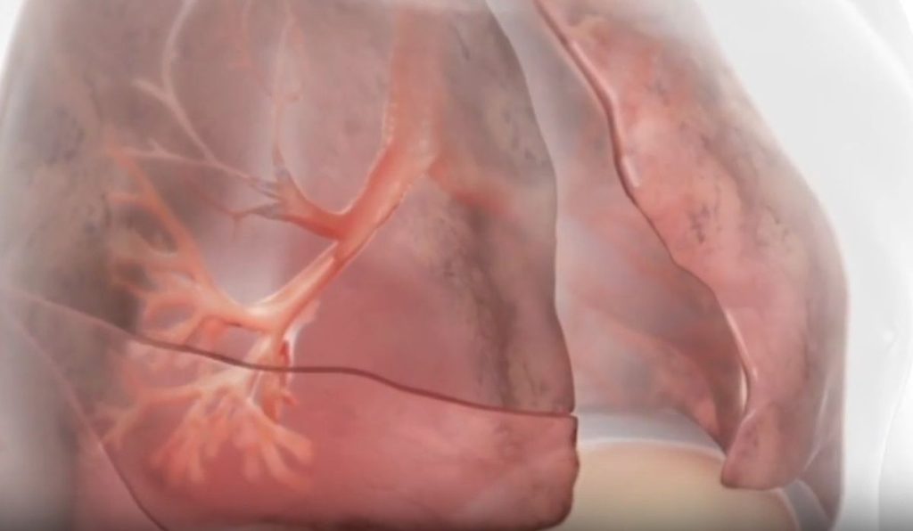 Scoperte terapeutiche per la BPCO con enfisema: nuove frontiere nella cura respiratoria.