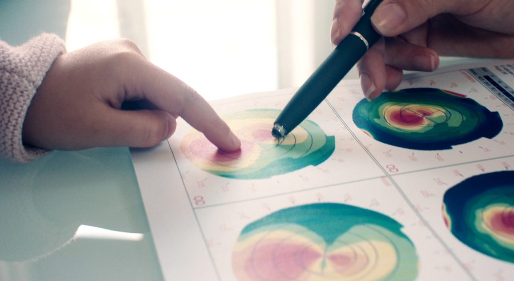 Cheratocono: nuova cura innovativa per la salute degli occhi a Roma, per oltre 100 milioni di giovani.