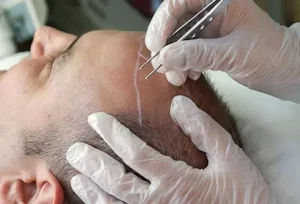 Hair Transplant: Permanent Results and Effectiveness Explained in Simple Terms