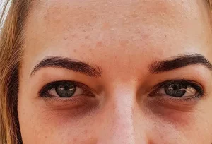 Elimina il gonfiore sotto gli occhi con metodi efficaci e naturali comprovati