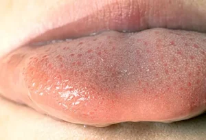 Come Eliminare la Papillite Linguale Transitoria in Modo Naturale e Veloce