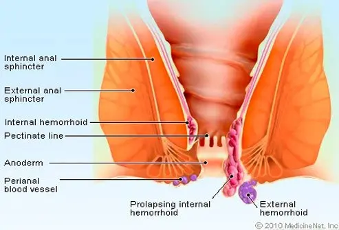 Durata e guarigione delle emorroidi esterne trombizzate spiegate chiaramente