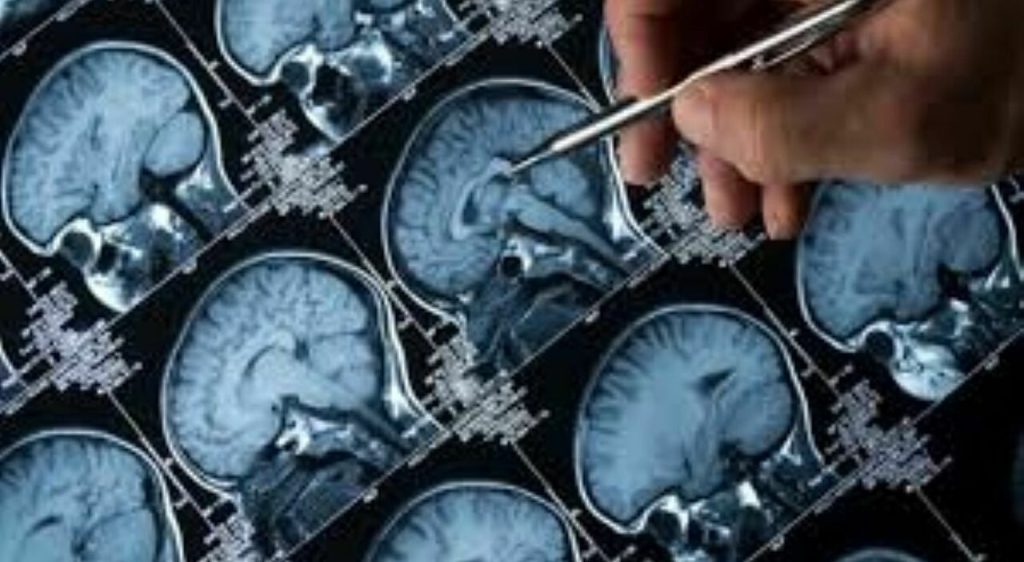 Allerta Alzheimer: rischio maggiore per chi vive nei Paesi del Nord Europa.