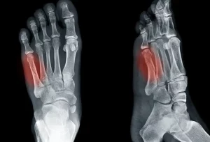 Cos’è la frattura di Jones e in cosa differisce dalla pseudo-frattura di Jones? La frattura di Jones...