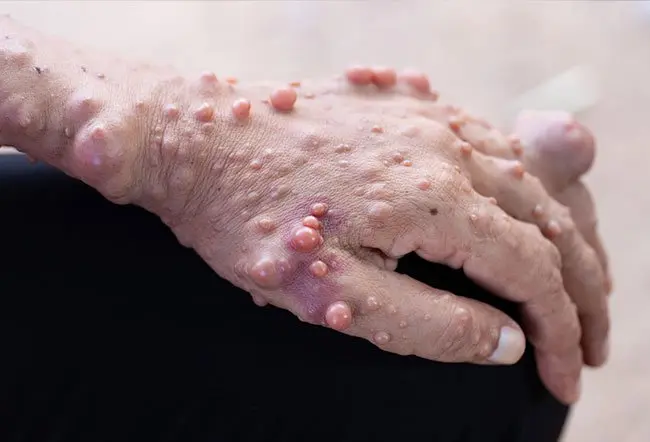 Aspettativa di vita e prospettive per chi convive con la neurofibromatosi