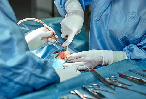 La rimozione dei polipi nasali viene solitamente eseguita tramite chirurgia endoscopica, una tecnica...