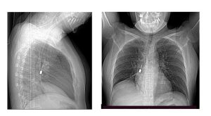 Cacciavite odontoiatrico trovato nel bronco: i medici risolvono mistero di tosse e dolore al petto.
