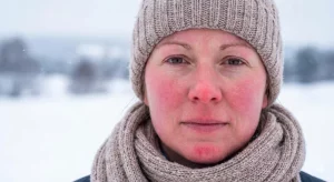 Rosacea e couperose in inverno: perché peggiorano e come intervenire