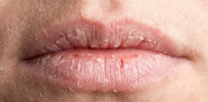 Labbra Secche in Inverno: Come Risolvere il Problema in Modo Efficace