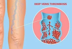 Cause comuni di D-Dimero positivo: coaguli e valori normali spiegati