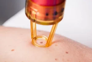 Come riconoscere i primi segnali di un neo canceroso sulla pelle