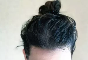 Greasy Hair: 9 Causes Explained and Effective Remedies to Control Oiliness