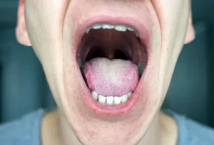 Scalloped Tongue: 5 Cause Inaspettate e Cosa Significa per la Tua Salute