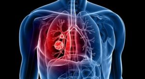 30 Cause Comuni di Cancro: Scopri Come Prevenirle Efficacemente e Mantenerti in Salute