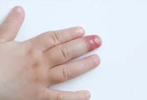 Come Trattare un Dito Infiammato e Dislocato: Procedura Efficace e Veloce