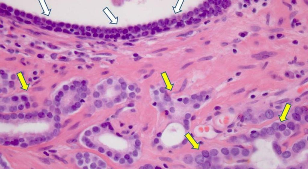 Una proteina accelera la diffusione delle metastasi in alcuni tumori, impattando gravemente la Vimentina.