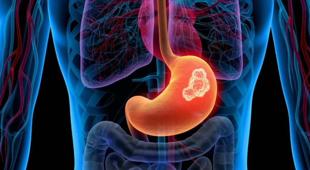 Nuovo trattamento combinato offre speranza ai pazienti con tumore avanzato allo stomaco.