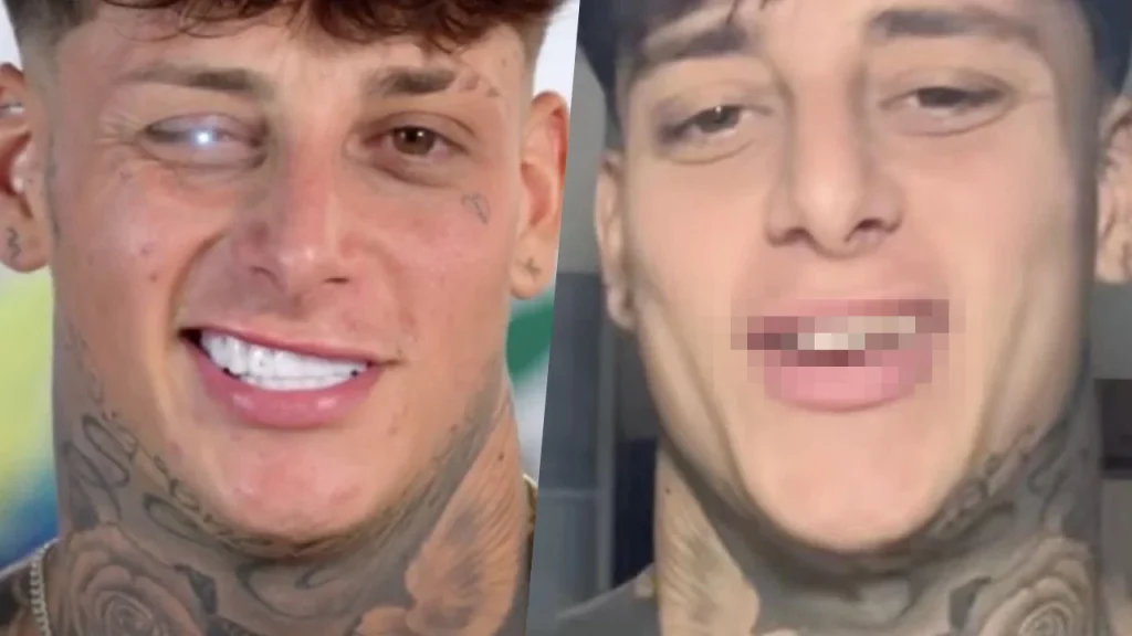 Denti naturali prima delle faccette: il vero sorriso senza ritocchi