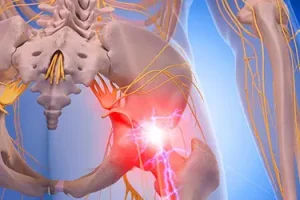Sciatic Nerve Pain Relief: Effective Methods to Alleviate Discomfort Fast