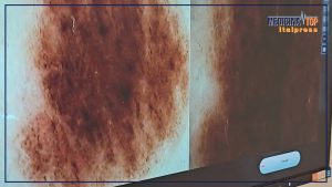 Aumento dei tumori cutanei non melanoma in Italia: le cause e l’importanza della prevenzione.