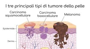 Melanoma: proteggiti con abbigliamento adeguato e scopri i sintomi da non sottovalutare