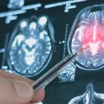 Top ospedali in Italia per il trattamento dell’aneurisma cerebrale non rotto