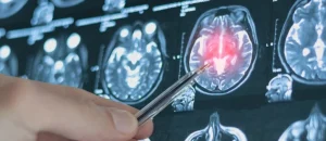 Top ospedali in Italia per il trattamento dell’aneurisma cerebrale non rotto