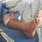 Fratture di tibia e perone, di cosa si tratta e come intervenire