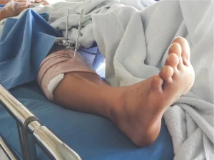 Fratture di tibia e perone, di cosa si tratta e come intervenire
