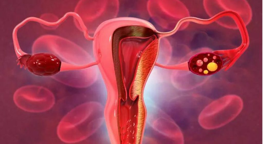 Digiuno potenzia la chemioterapia nel tumore ovarico, nuova ricerca del Gemelli.