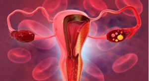 Digiuno potenzia la chemioterapia nel tumore ovarico, nuova ricerca del Gemelli.