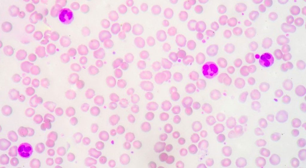 Nuova terapia quadrupla per mieloma multiplo: maggiore efficacia e minori effetti collaterali.