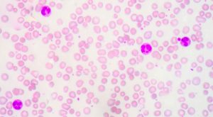 Nuova terapia quadrupla per mieloma multiplo: maggiore efficacia e minori effetti collaterali.
