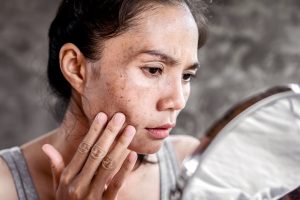Scopri come ridurre le macchie solari dal viso: guida pratica e approfondita.