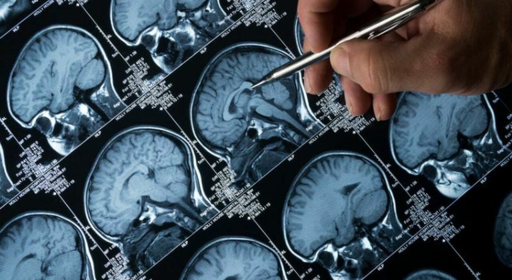Cerotto innovativo per combattere il glioblastoma: scopri come funziona questa rivoluzione medica.