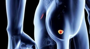 Tumore alla prostata: promettente trattamento sperimentale riattiva l’immunità e uccide le cellule tumorali.