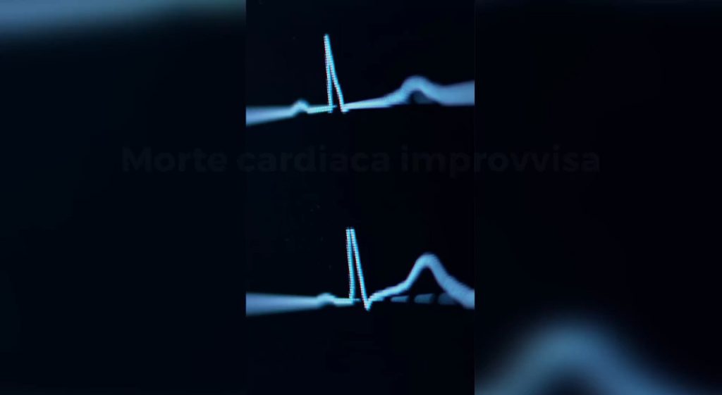 AI Rivoluziona la Diagnosi della Morte Cardiaca Improvvisa Leggendo l’ECG con Maggiore Precisione