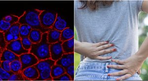 Mal di schiena e tumore al pancreas: segnali da non sottovalutare secondo l’oncologo