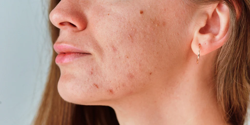 Bellezza naturale: addio perfezione, cresce il movimento della pelle reale