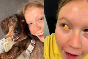 Donna si ferisce gravemente agli occhi dopo un errore emotivo durante il lutto per il cane.