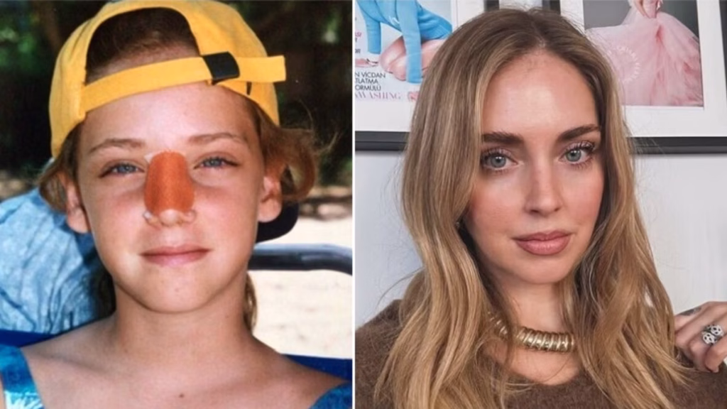 Il vero motivo dell’intervento al naso di Chiara Ferragni svelato: tutte le verità.