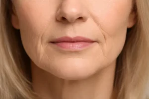 Rughe della marionetta: come intervenire per attenuarle e ritrovare un viso più disteso