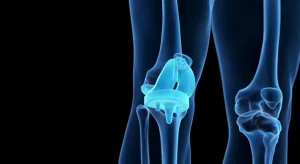 Innovativa tecnologia a Roma: robot personalizza protesi ginocchio per recupero rapido.