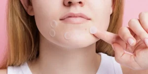 Pimple patches: funzionamento e top 5 migliori – Guida completa per una pelle perfetta.