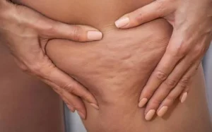 Lipedema, come riconoscerlo e contrastarlo prima di arrivare alla chirurgia