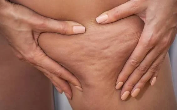 Lipedema, come riconoscerlo e contrastarlo prima di arrivare alla chirurgia